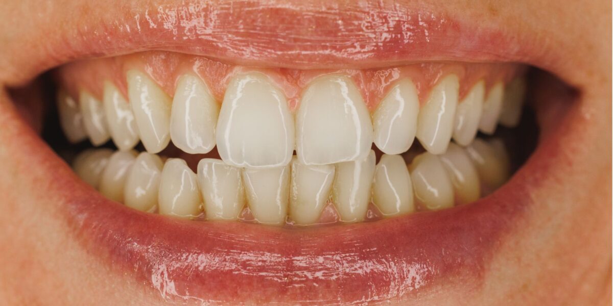 dientes amarillos