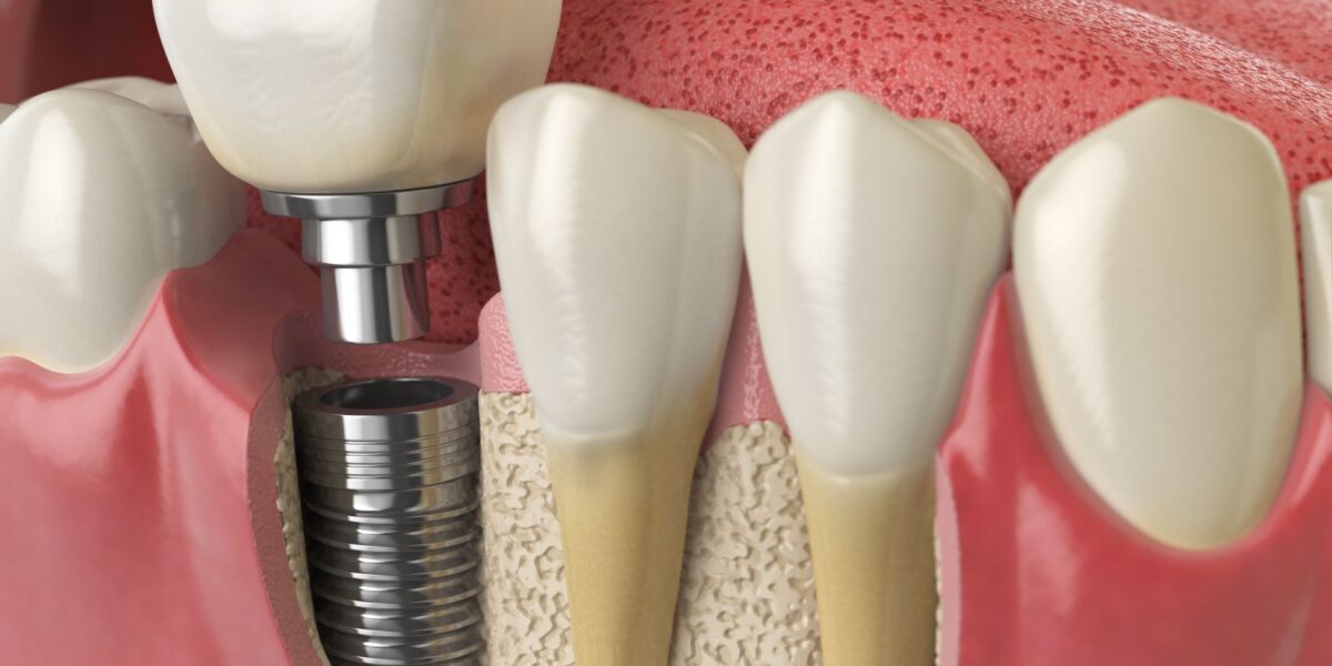 precios de implantes y mini implantes dentales en houston, texas